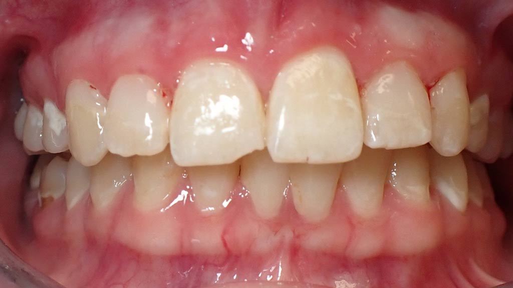 image of Fillings After