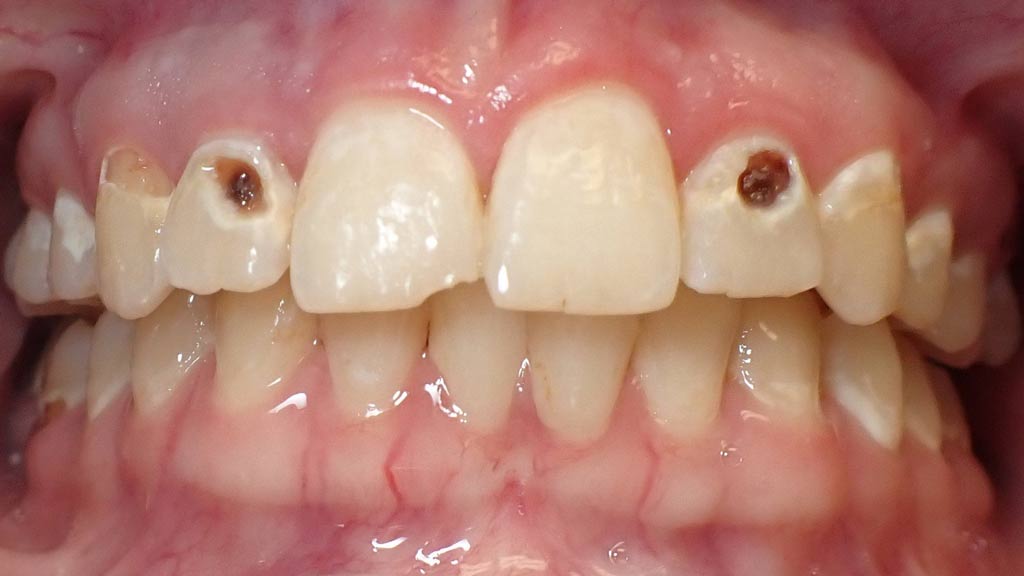 image of Fillings Before