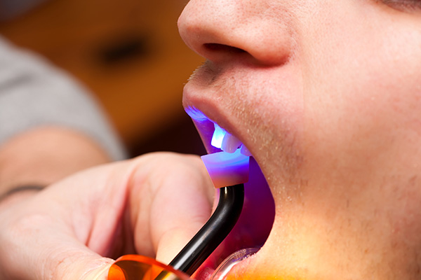 Dentist performing dental bonding treatment on patient at Cascade Dental in Medford, OR