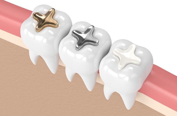 Rendering of teeth with 3 filling materials at Cascade Dental in Medford, OR