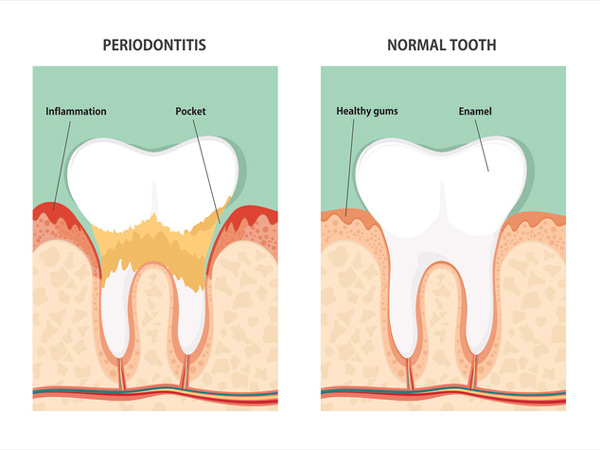 Diagram of periodontitis and healthy tooth