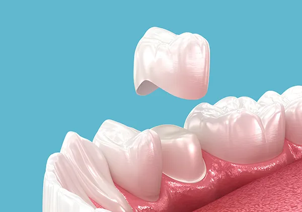 A shiny, pearlescent porcelain dental crown that beautifully matches the other teeth hovers above a damaged tooth that has been shaved down to receive it.